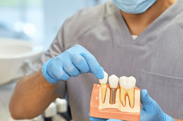 What Are Dental Implants & How Do They Work