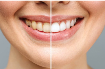 The Truth About Teeth Whitening: How Long Does It Last?